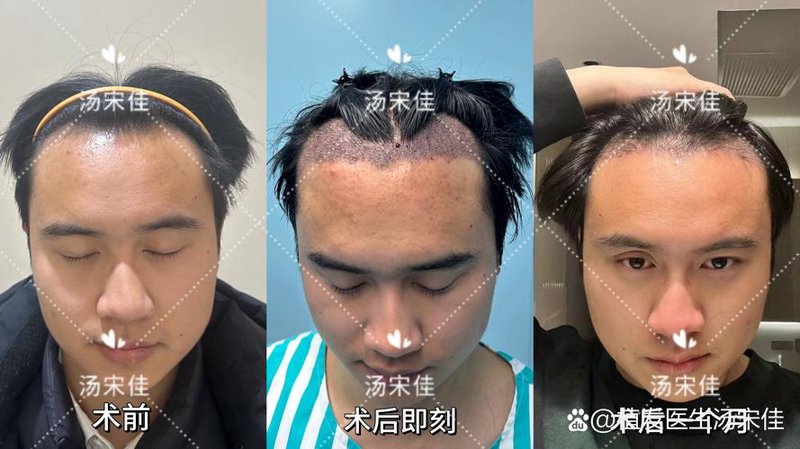 植发效果那些你不可不知的秘密