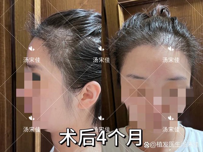 发际线种植