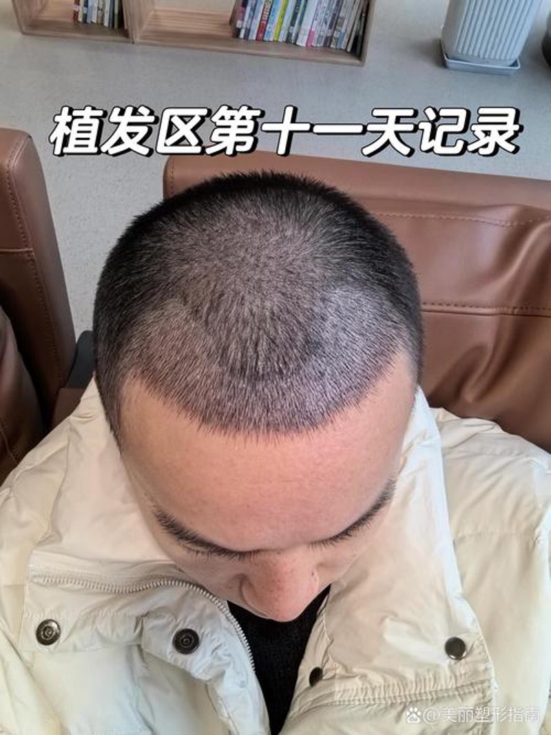 植发费用：揭秘背后的秘密