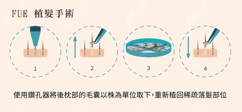 植发费用：一窥行业成本与价值