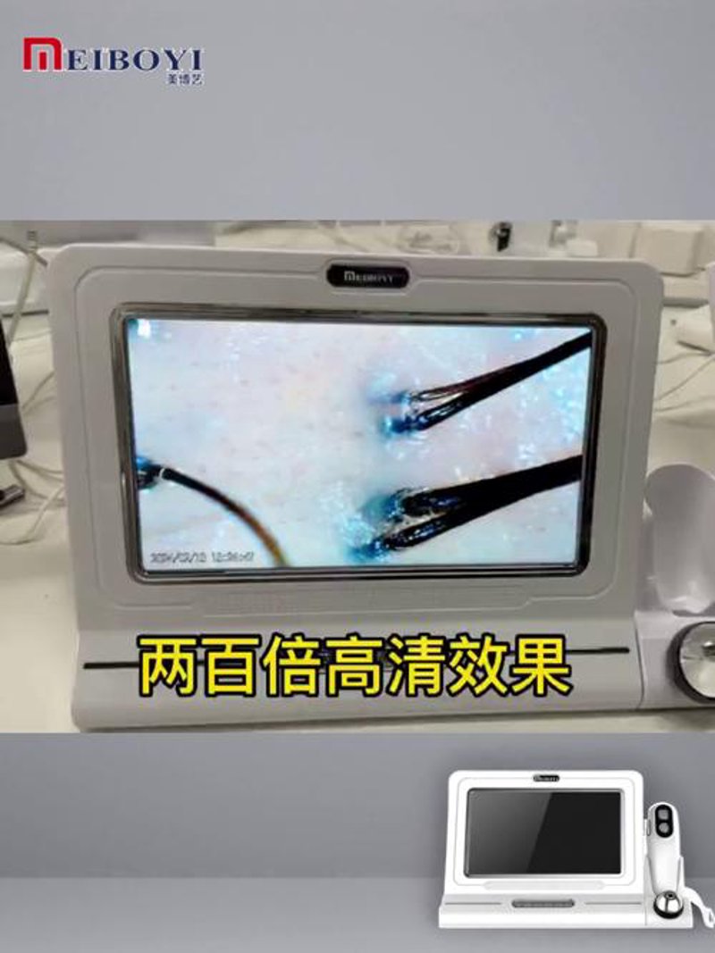 秃顶植发