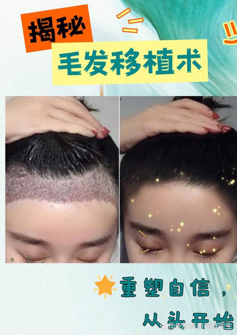 毛发移植