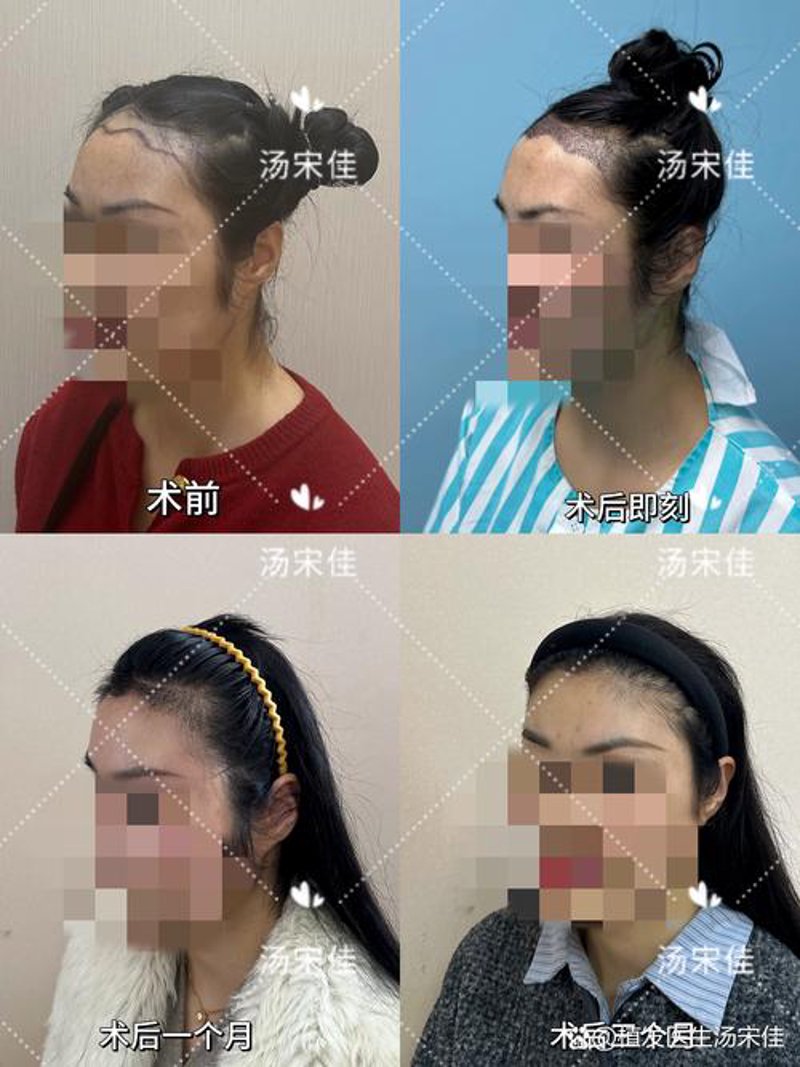 植发效果：从黯淡到焕然一新