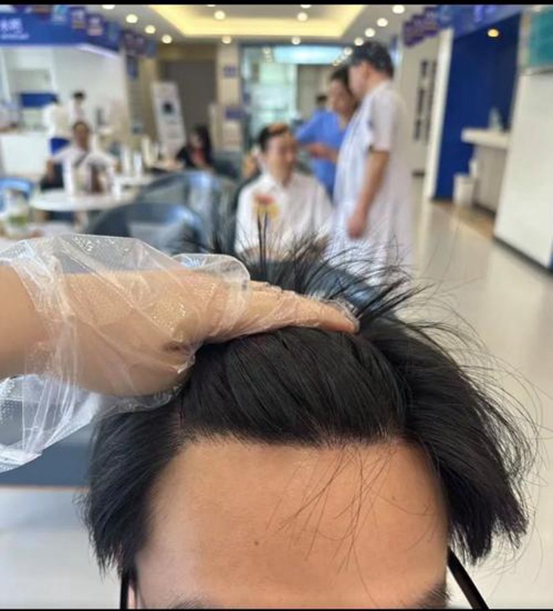 头发种植